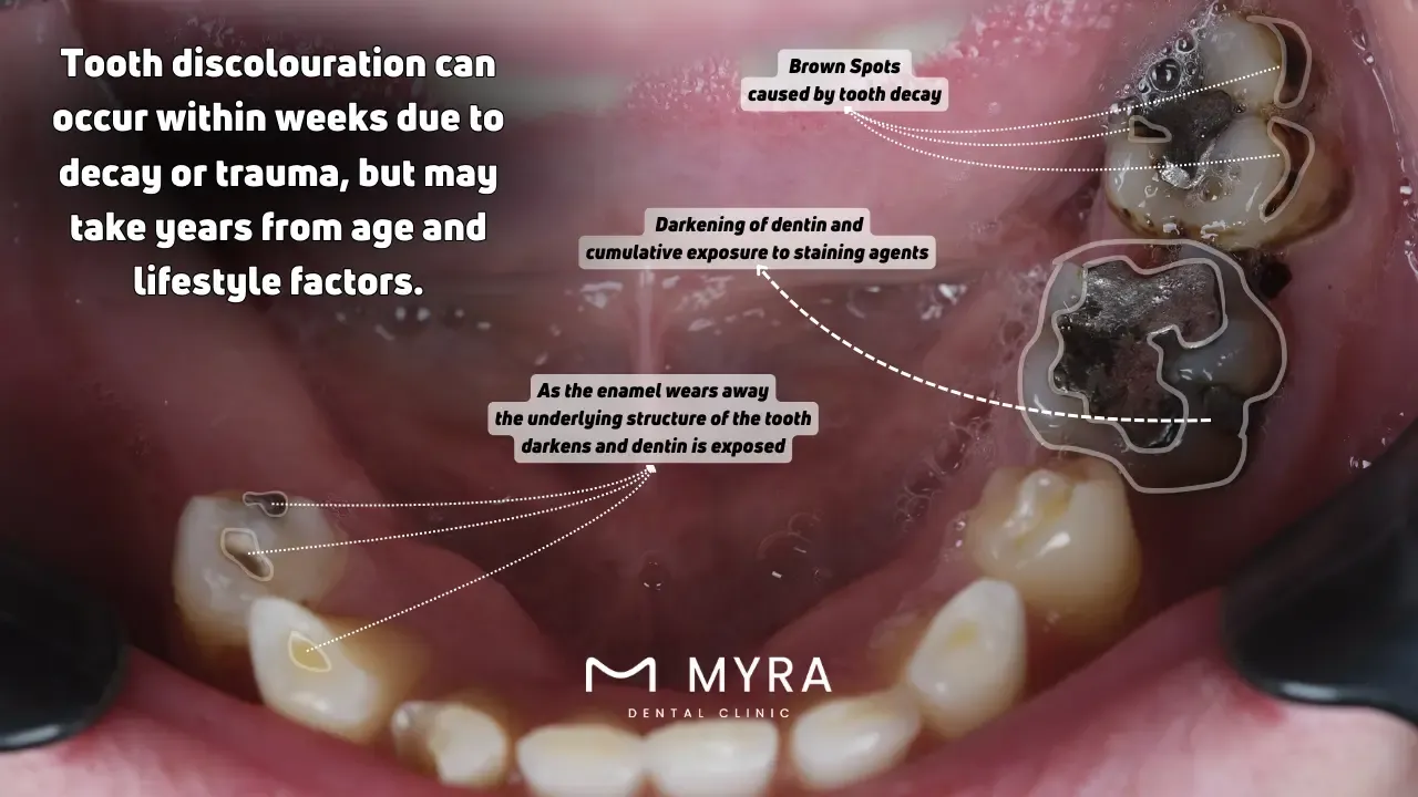 How long does it take for a tooth to go brown?