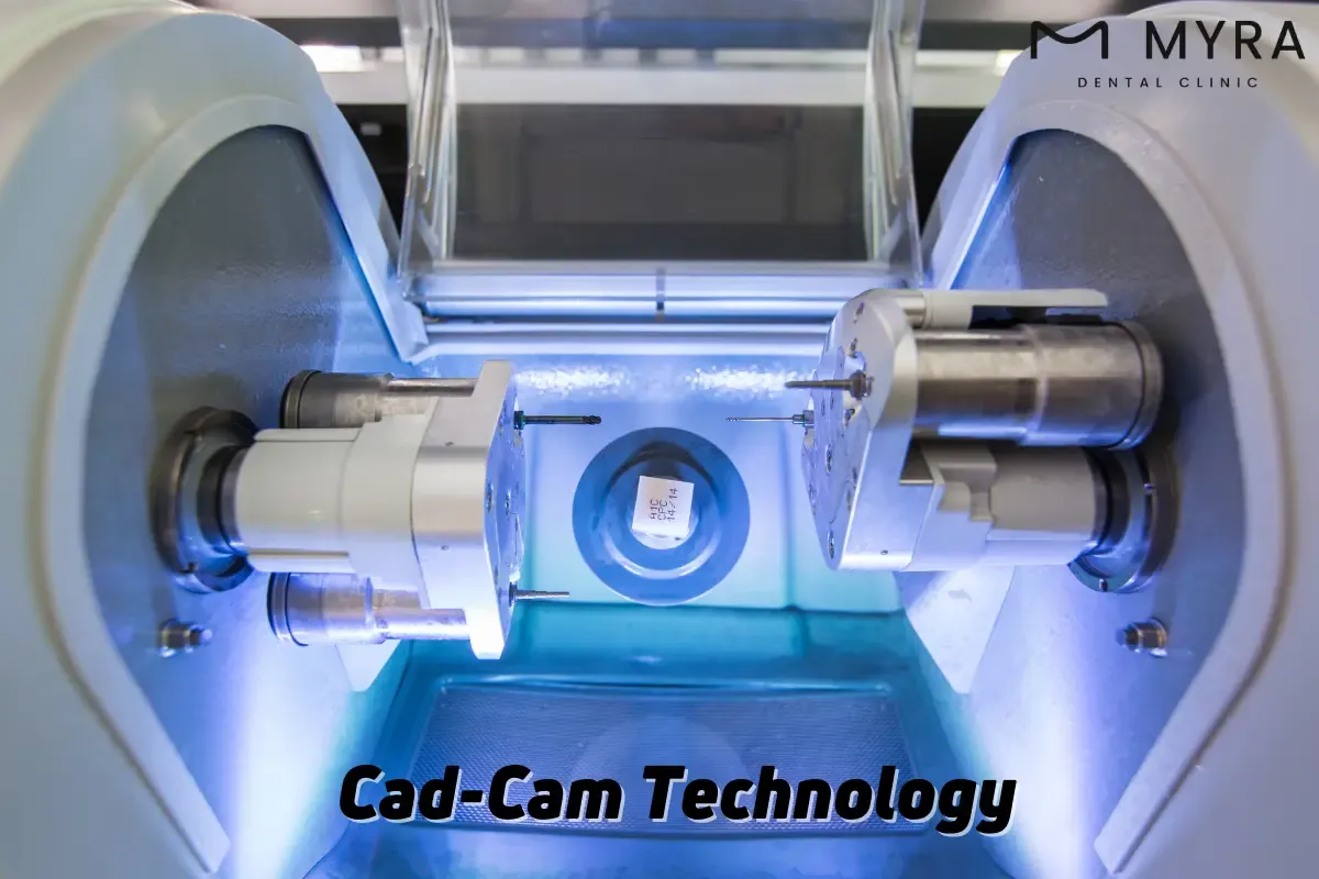 How long does it take to get an onlay?