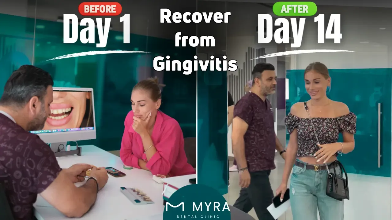 How long does it take to recover from gingivitis?