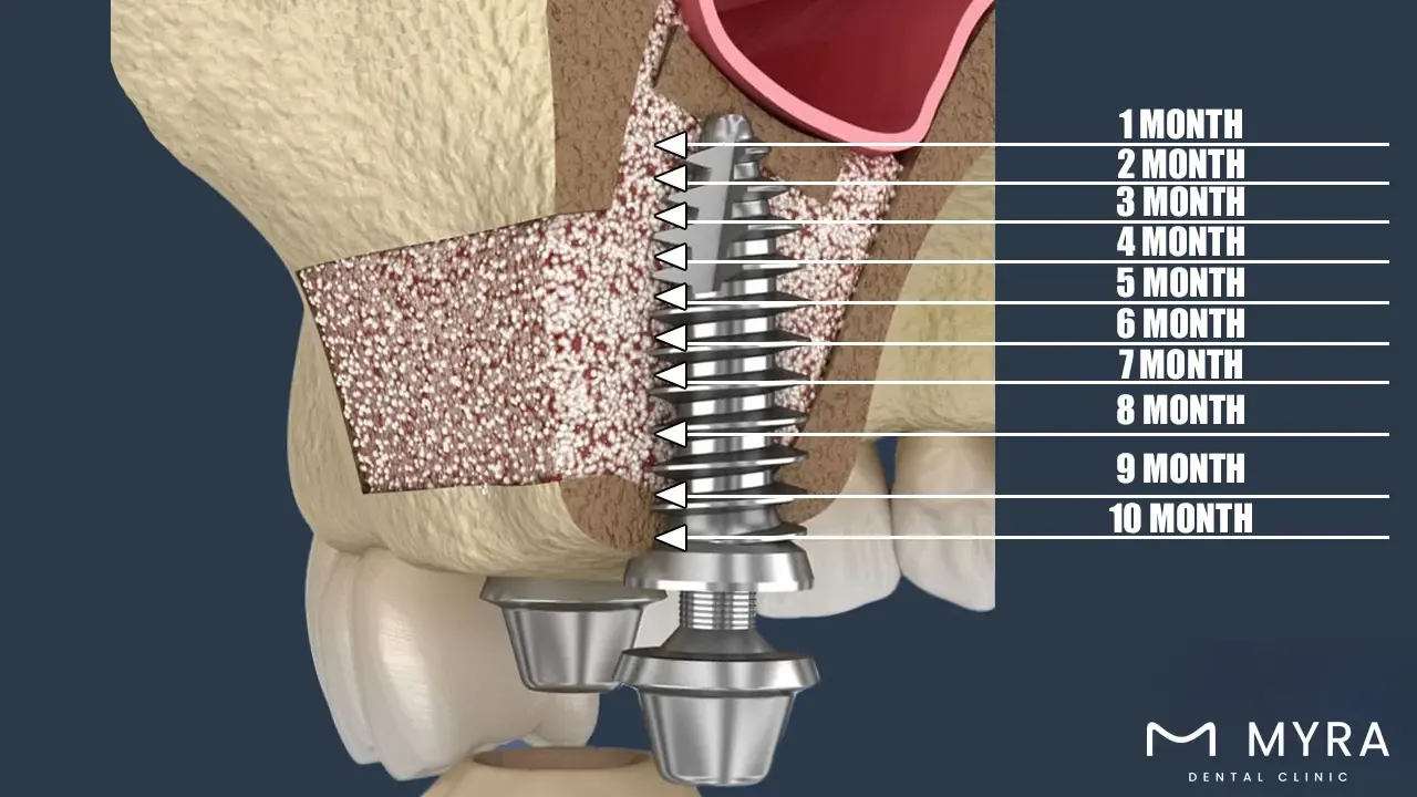 How long does it take to recover from sinus lift surgery?