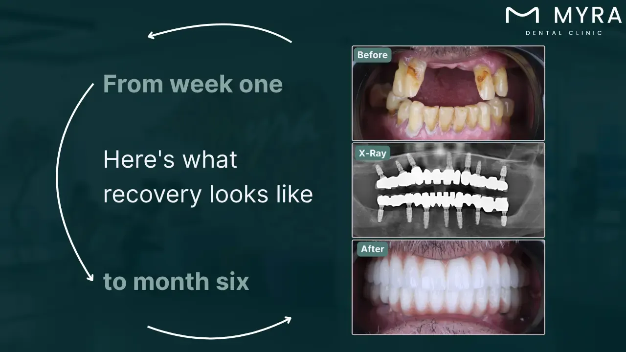 how long is the full recovery of dental implants?