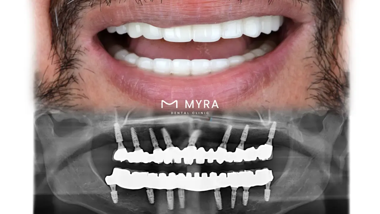 how-many-implants-are-normally-needed-for-an-upper-denture-implant.webp