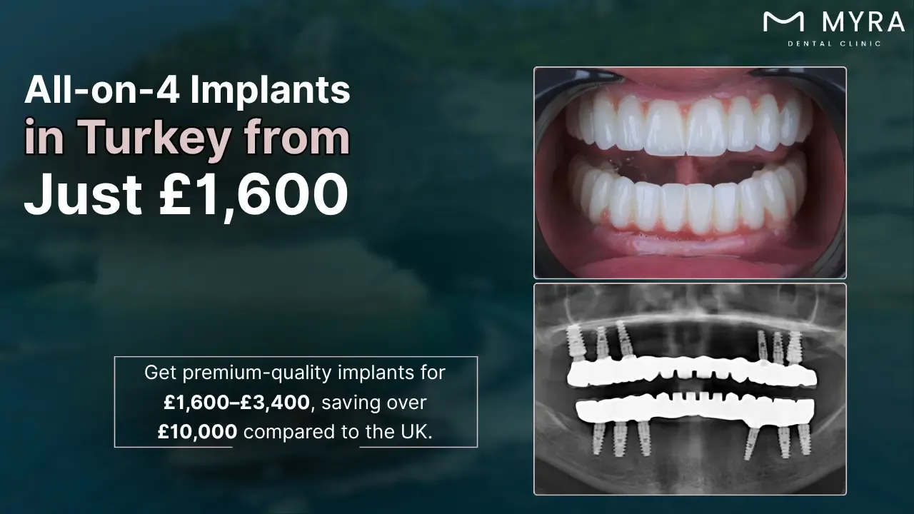 how-much-are-all-on-4-dental-implants-in-turkey.webp