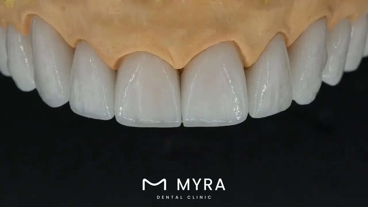 How much do veneers typically cost