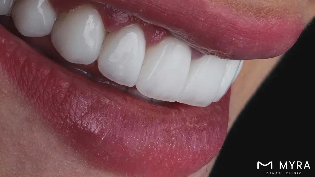 How much does a nasolabial fold treatment cost?