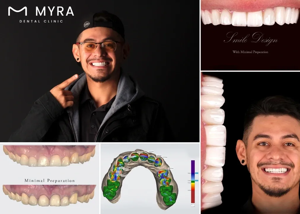 How much does a veneer cost in mexico