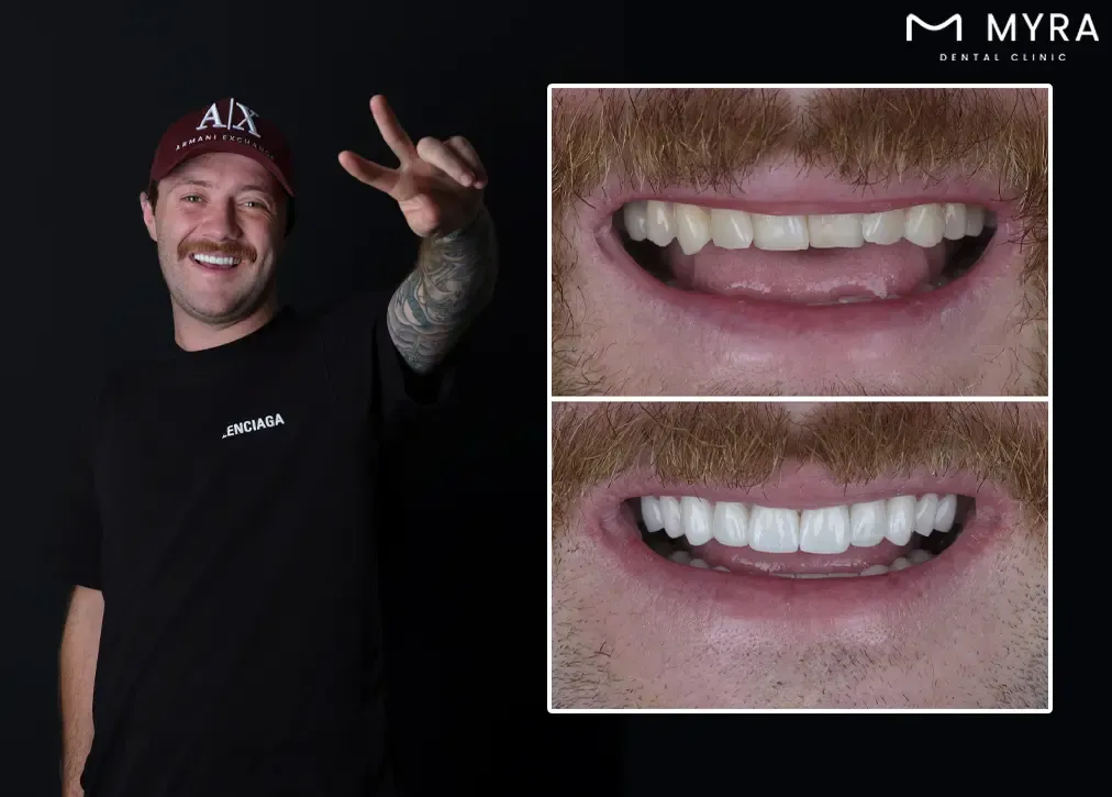  How much does a zirconia veneers cost