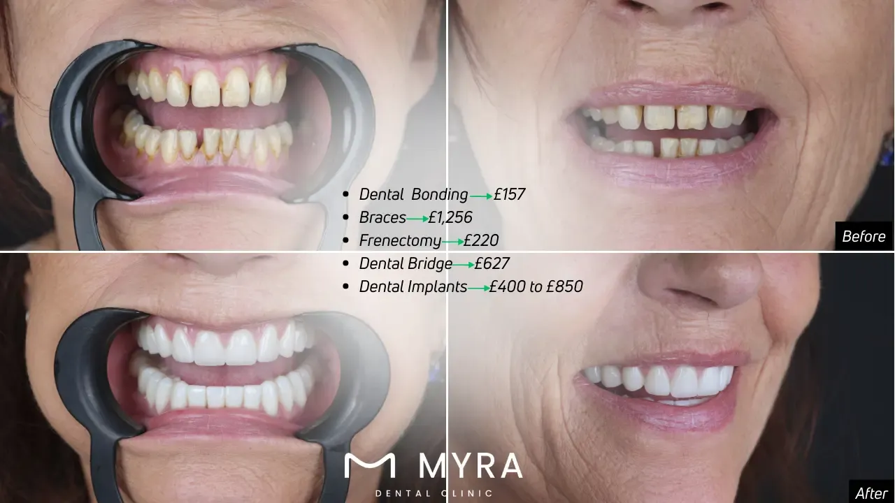 How much does diastema treatment cost?