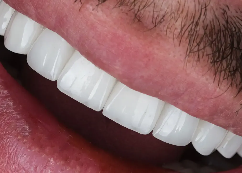 How much is the average cost of dental crowns in turkey?