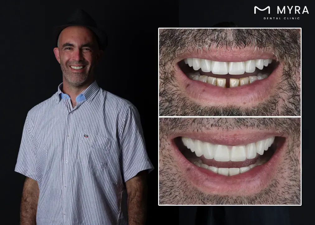 How much maintenance does an emax dental crown require