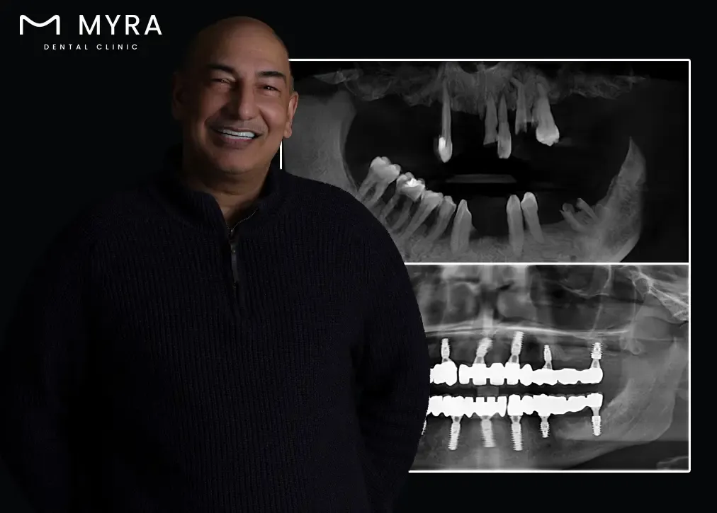 How to care for a tooth extraction
