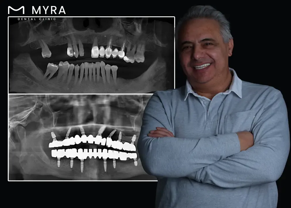 How to explain the concept of tooth extraction in turkey