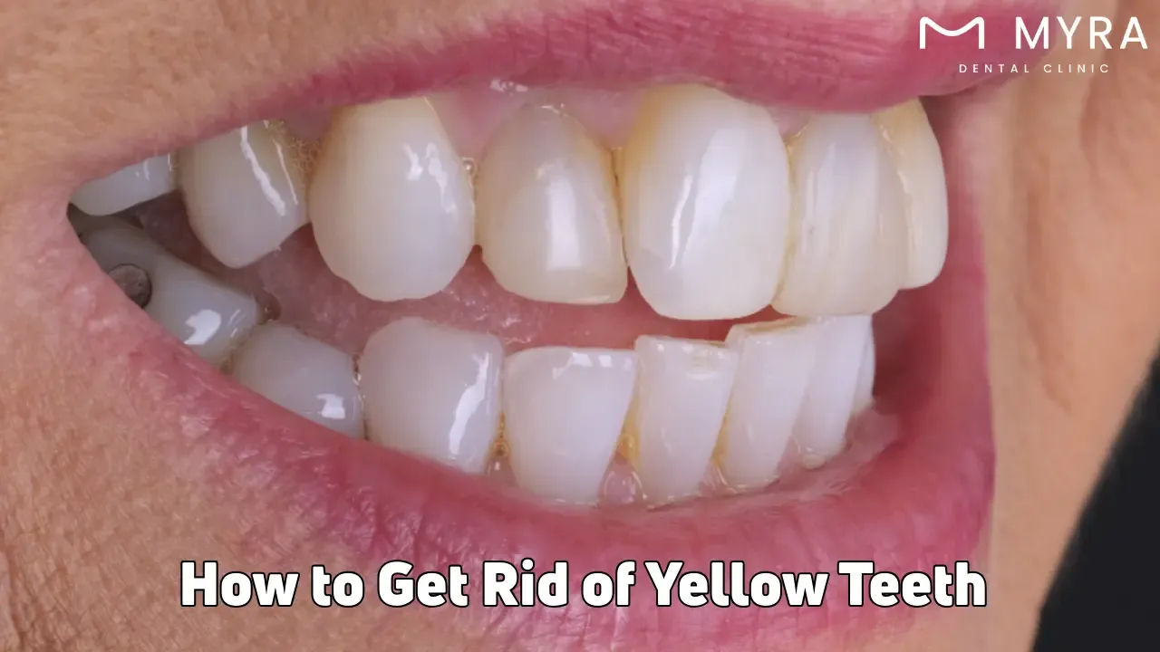 How to get rid of yellow teeth: Remedies and causes