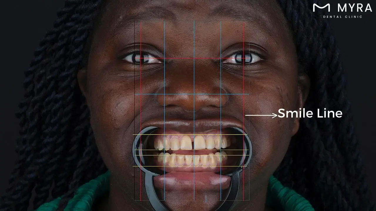 How to identify the quantity of dental veneers needed
