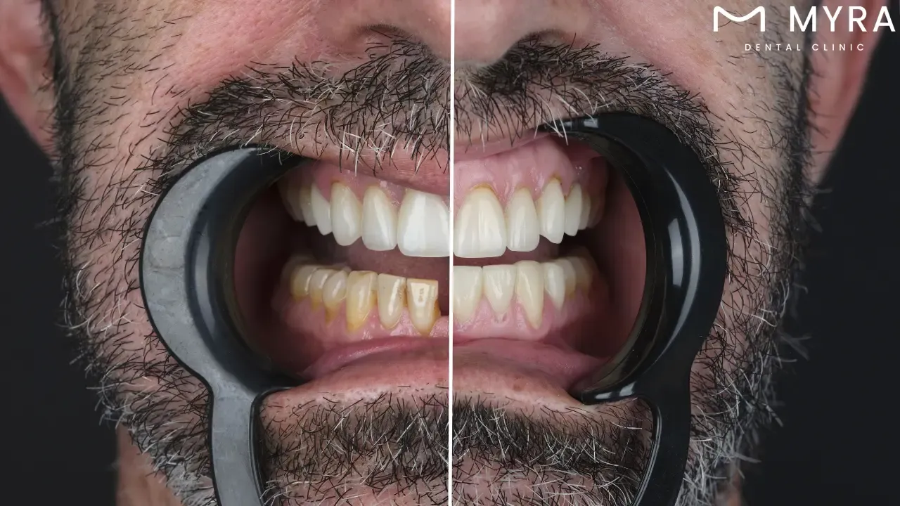 How to prevent veneers from staining