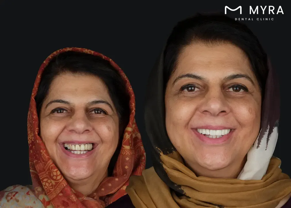 How to reconcile modern cosmetic dentistry practices like veneers with islamic values