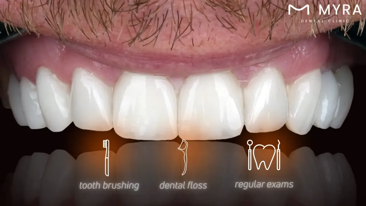 How to take care of dental veneer