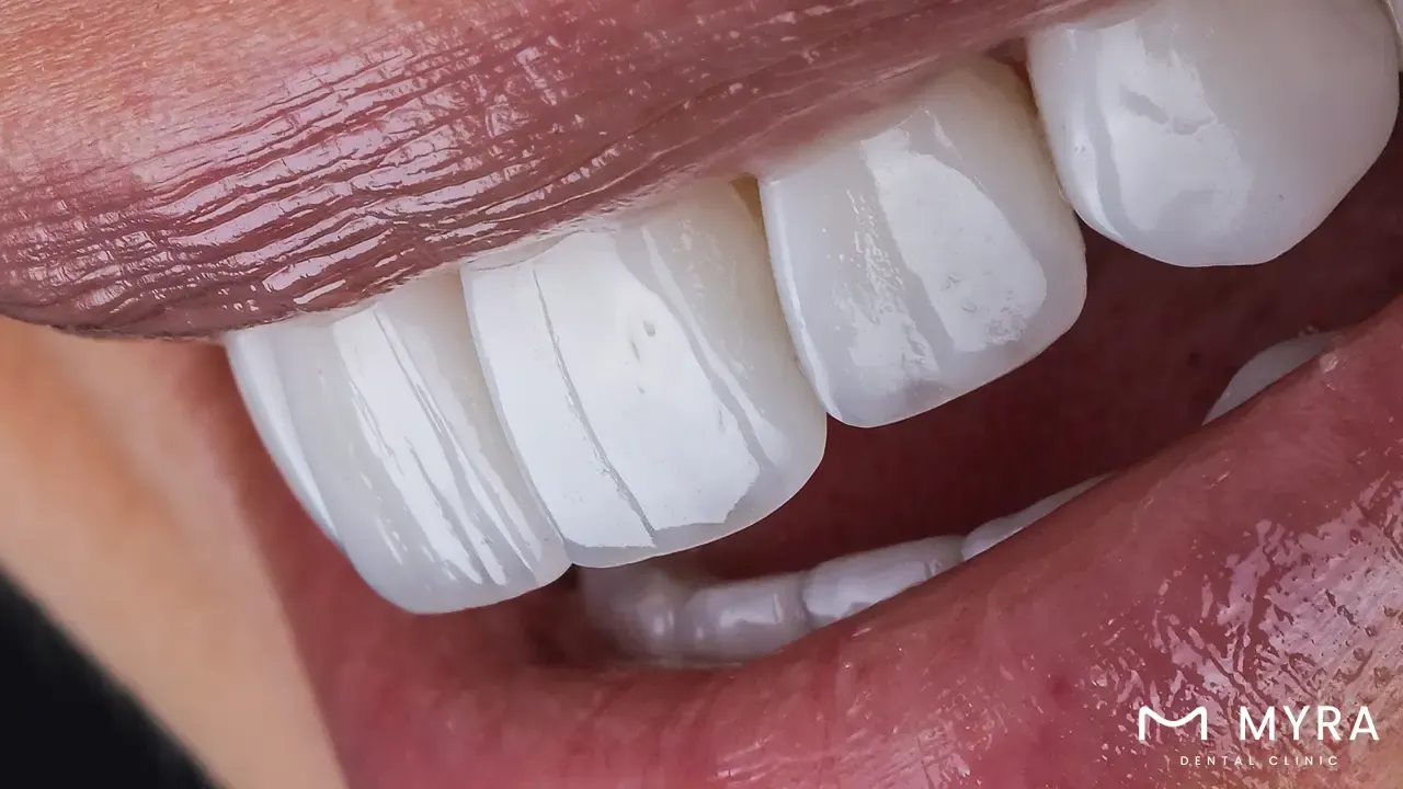 How tooth deficiencies affect facial aesthetics