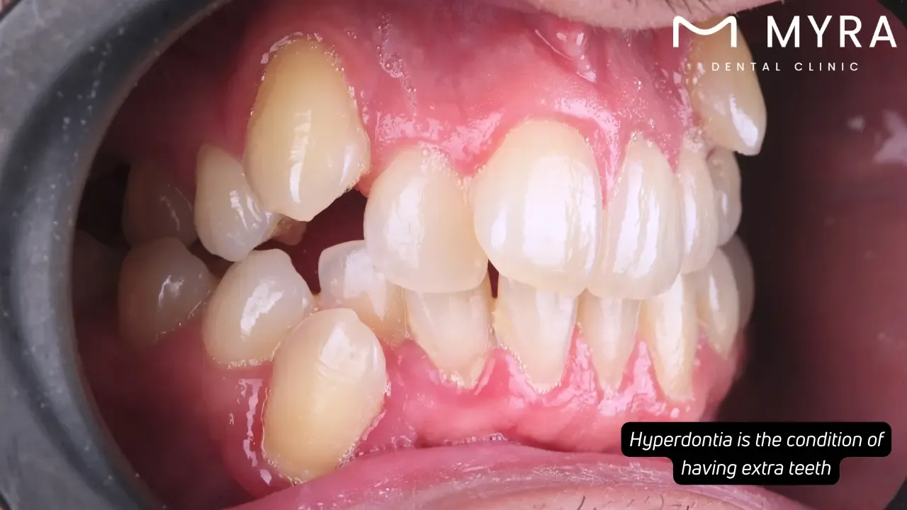 Hyperdontia (extra teeth): Symptoms, causes, and treatments