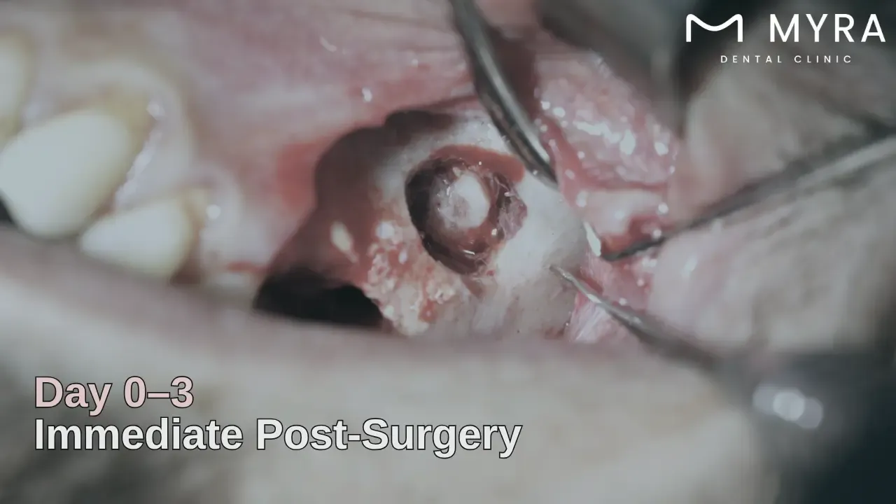 immediate post-surgery of bone graft