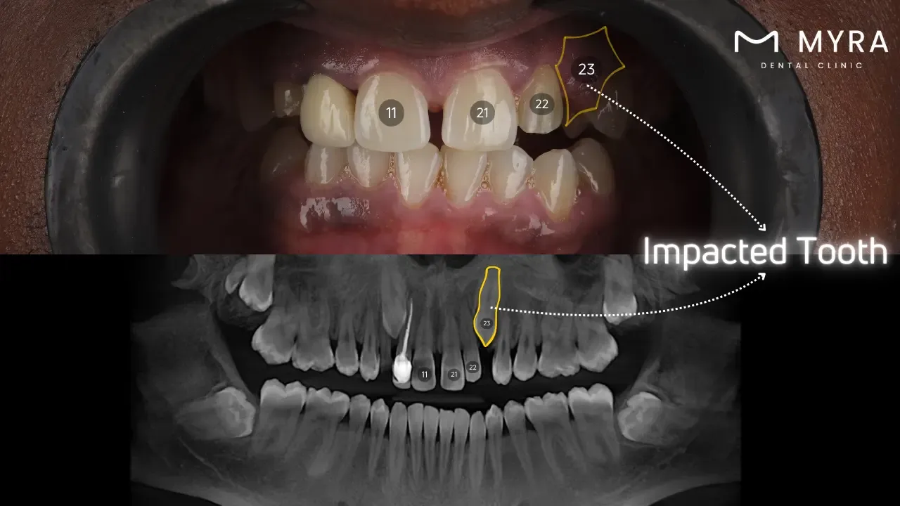 Impacted teeth: Symptoms, treatment, and causes