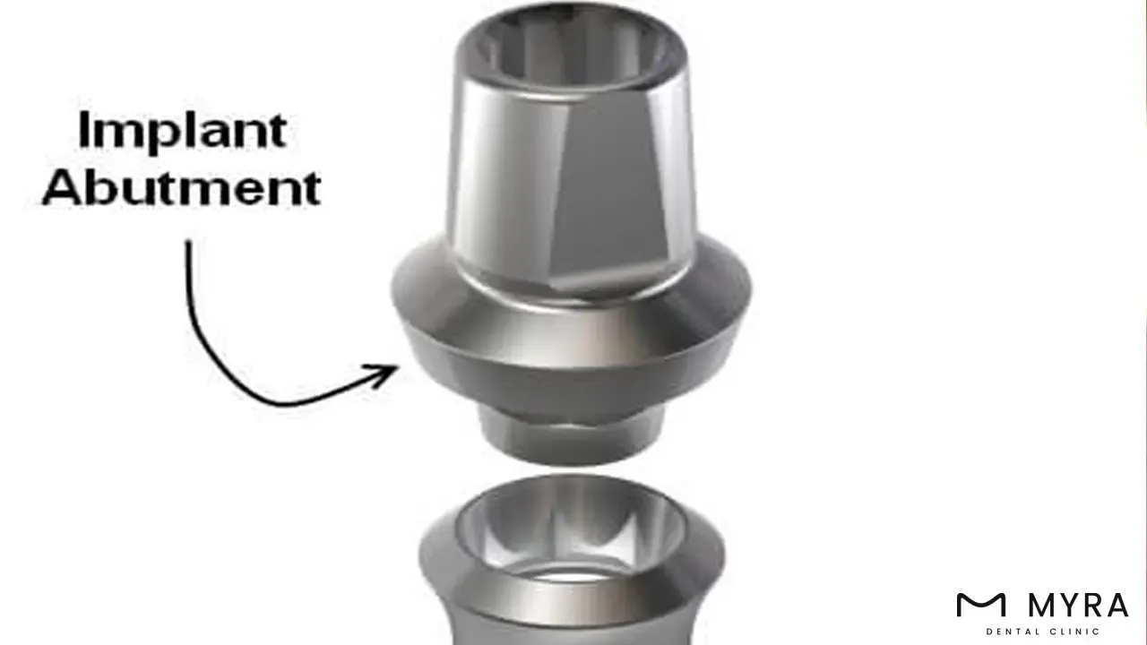 implant abutment