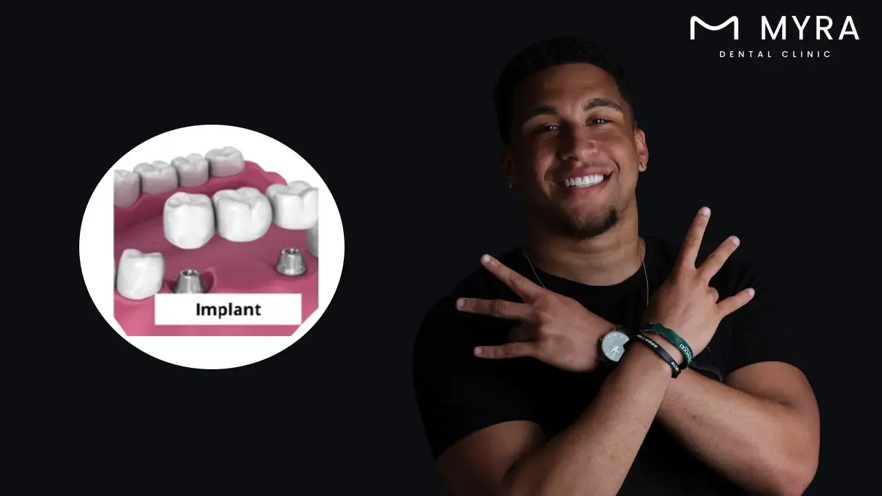 implant-supported dental bridge