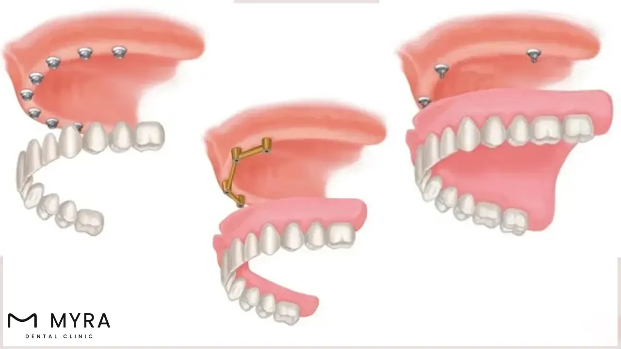 implant-supported dentures and bridge dentures