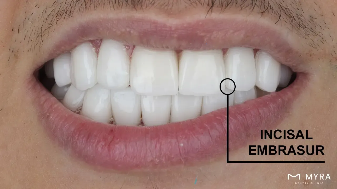 Incisal embrasure