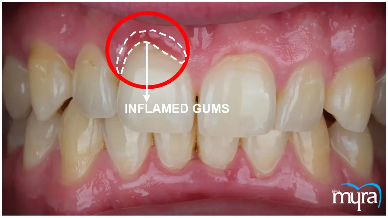 Inflamed gums