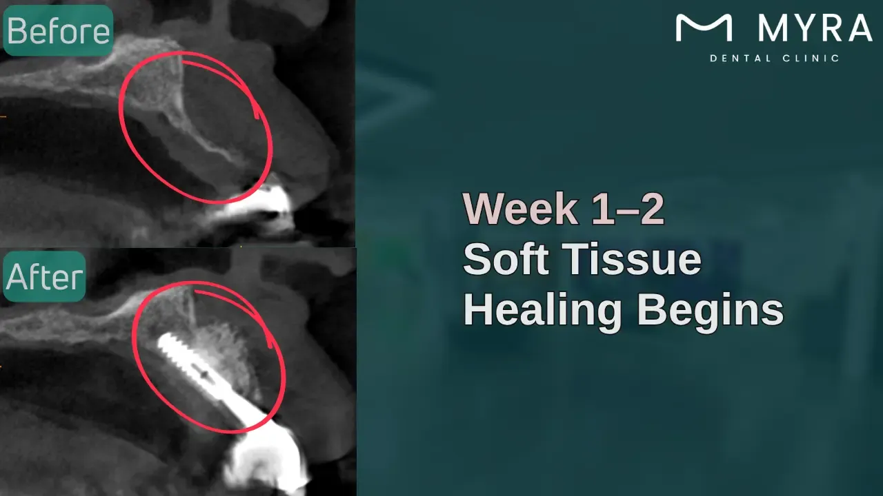 initial healing and blood clot formation