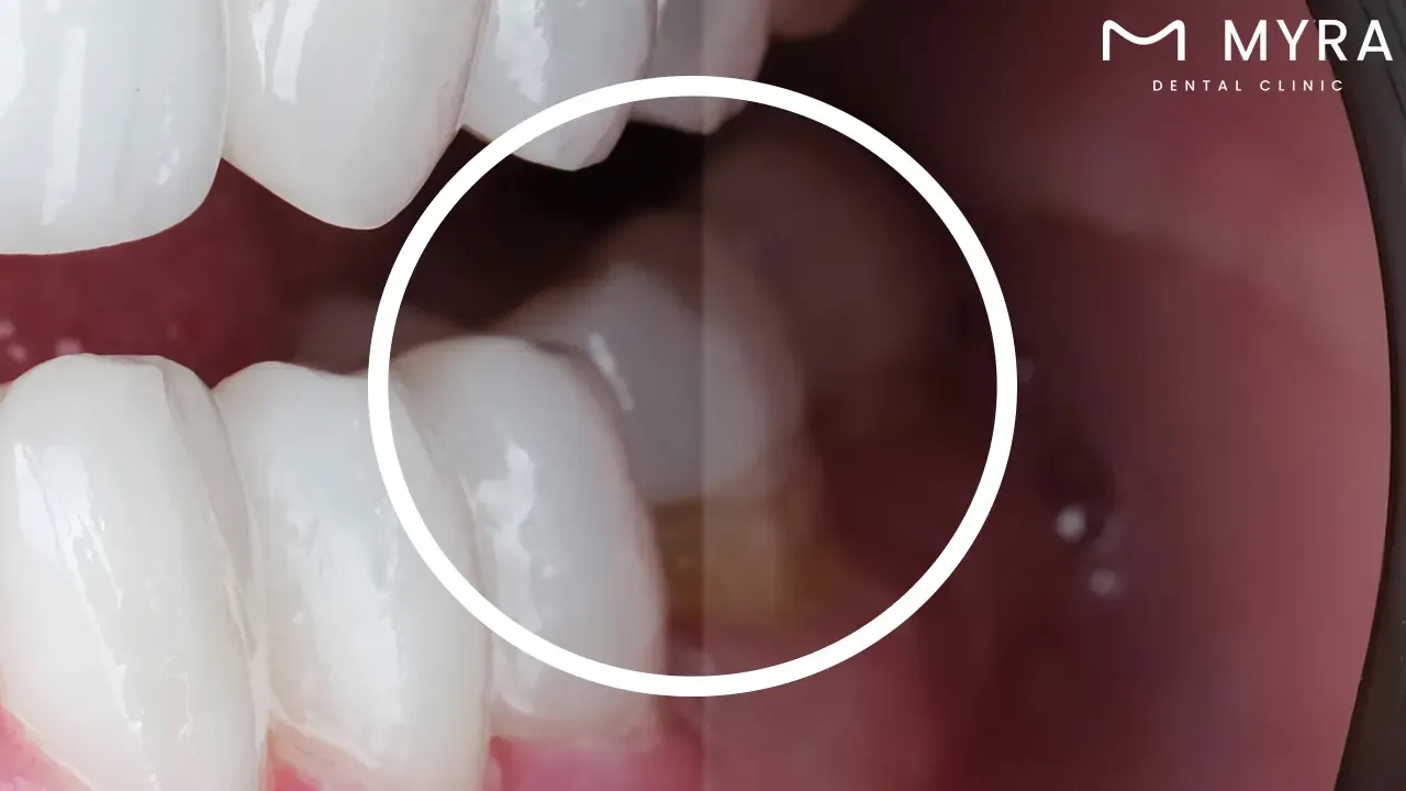 inlays: definition, importance and types