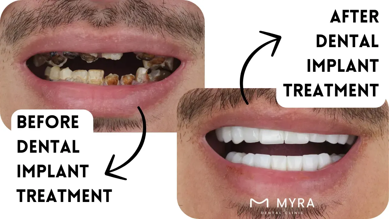 insurance coverage for teeth implants