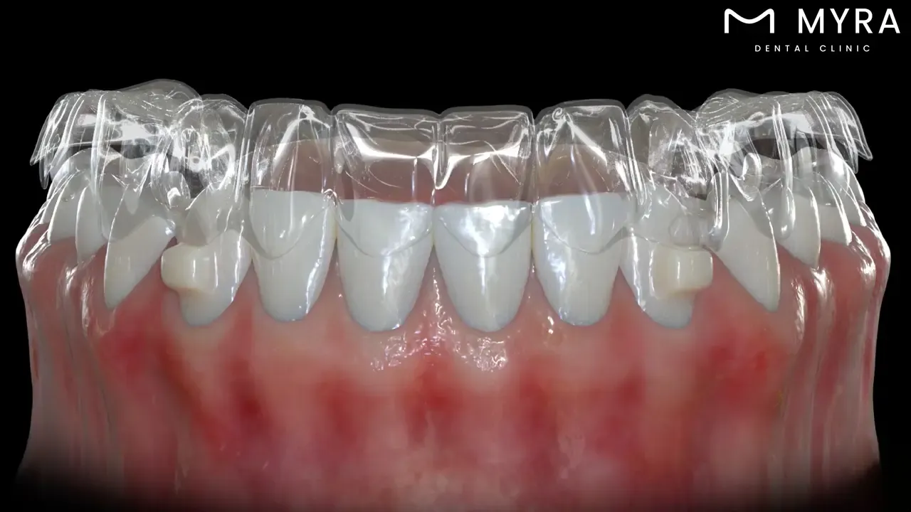 Invisalign for a narrow smile