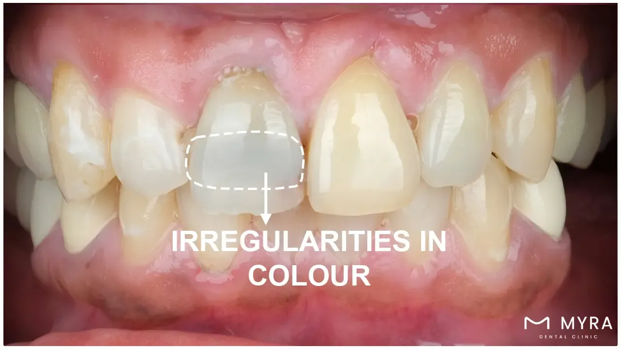 Irregularities in colour