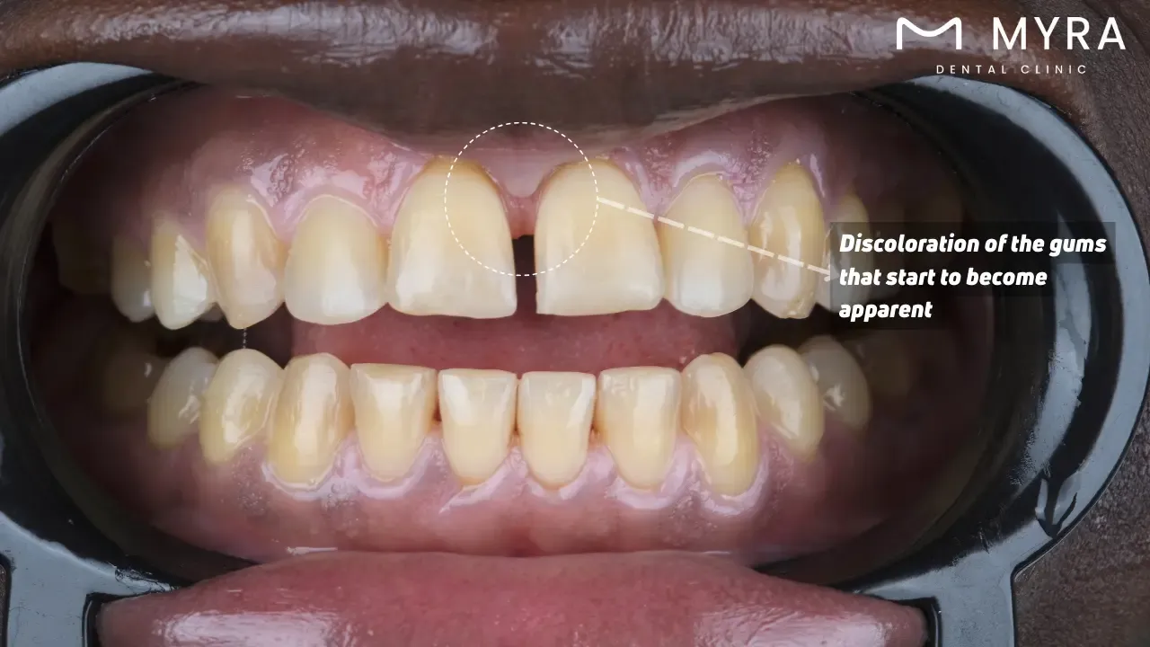 Is diastema related to gum disease?