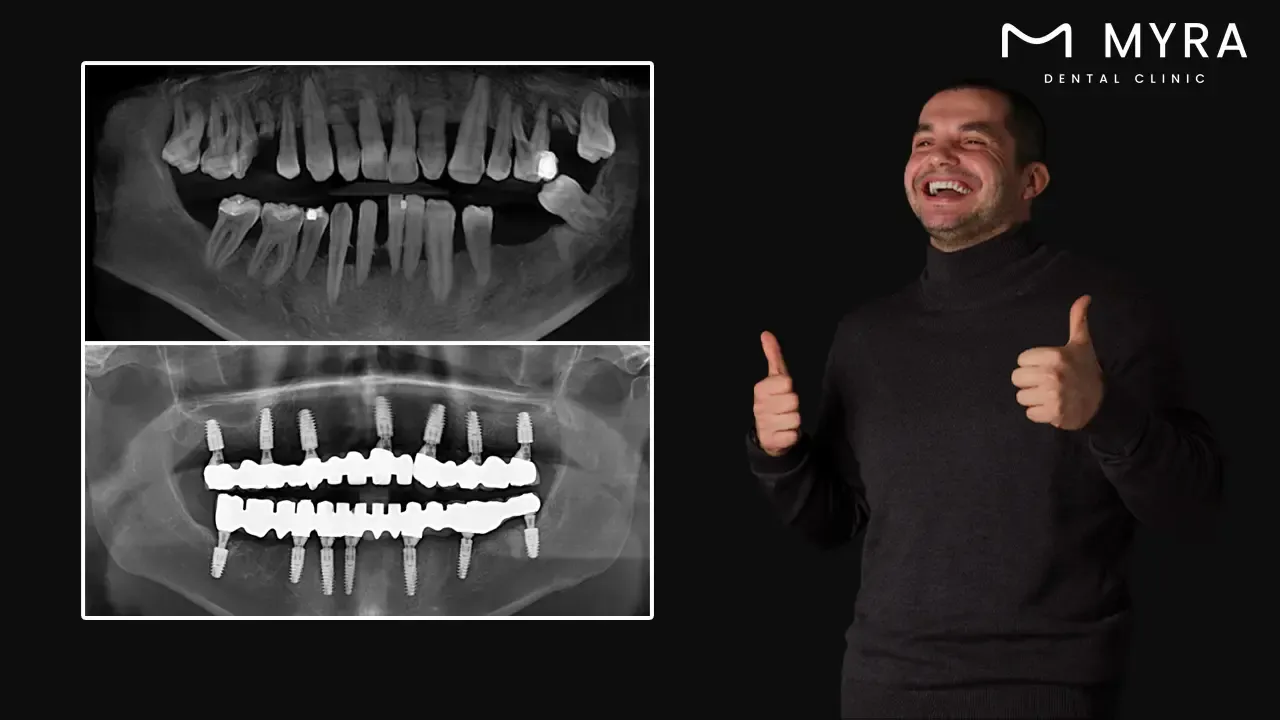 is it worth it to get a dental bridge?