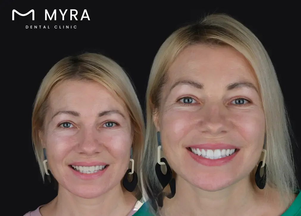 is there a risk of getting new teeth in turkey?