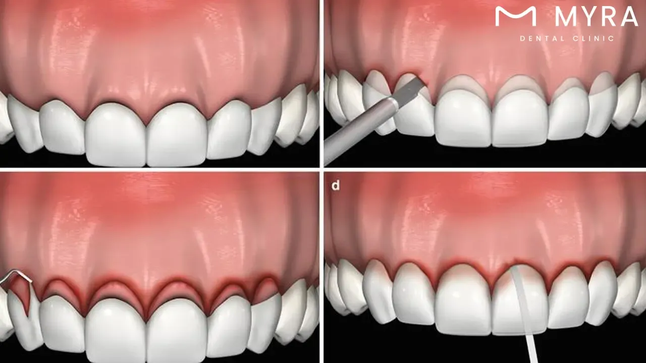 Laser gum contouring