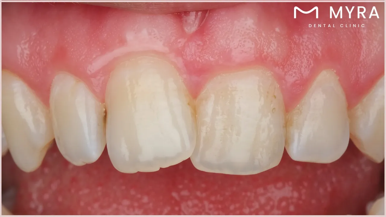 malocclusion of the teeth: definition, causes, and types