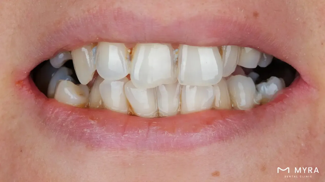 Malocclusion or crowded teeth
