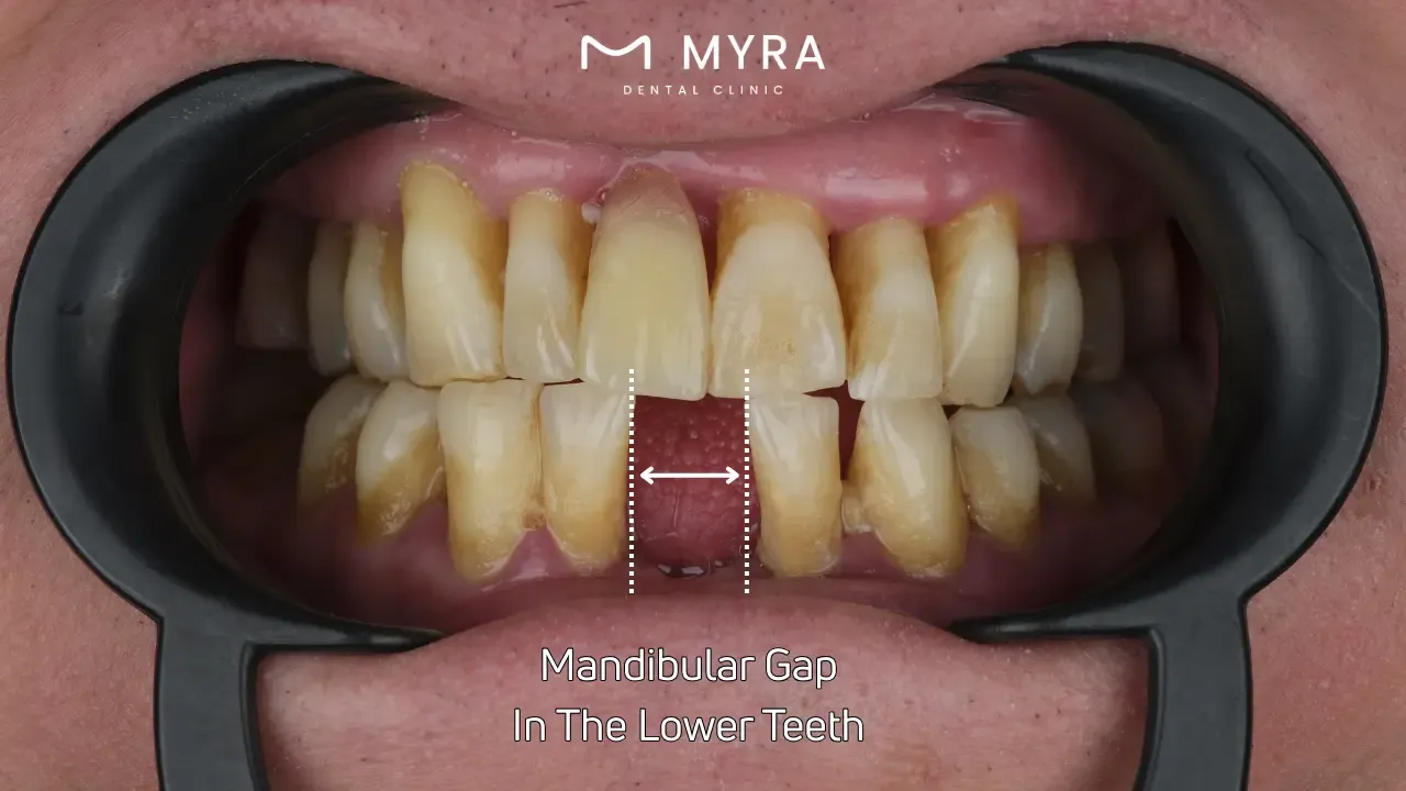 Mandibular gap between teeth