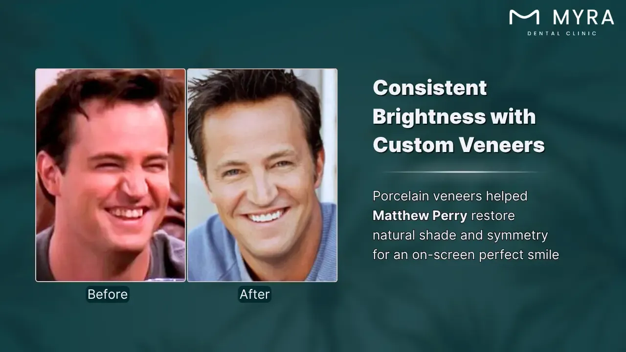 matthew perry's smile makeover