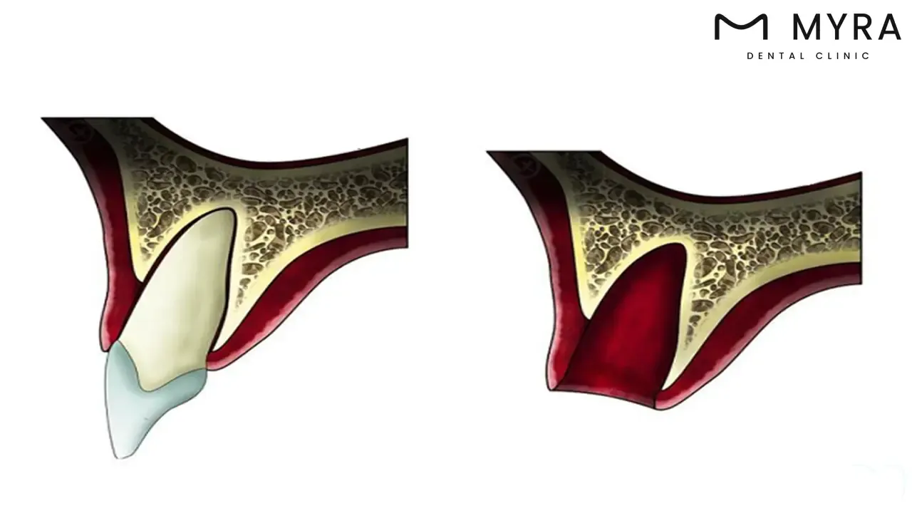 Maxillary central incisors: Definition, anatomy, and common procedures