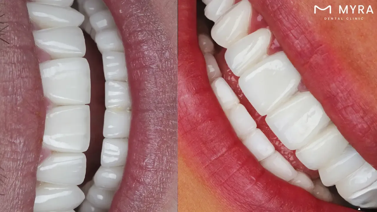 Microthin veneers