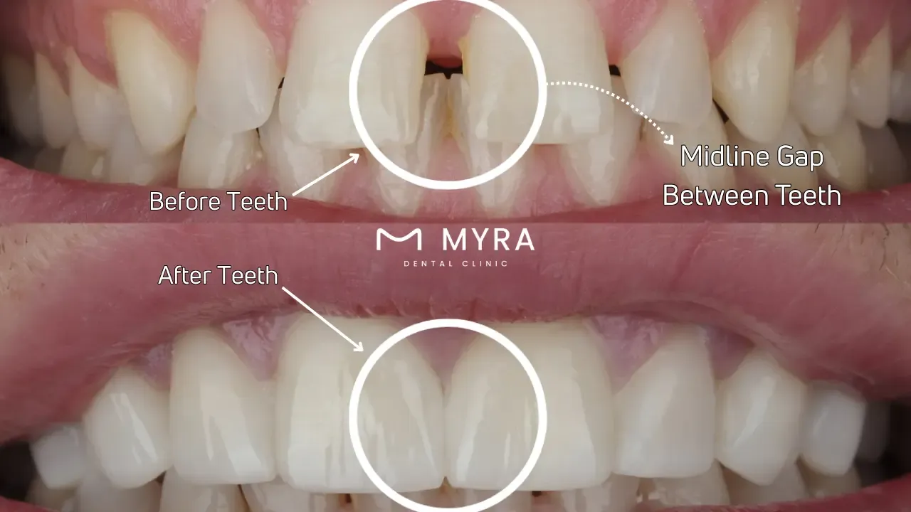 Midline gap between teeth (midline diastema)