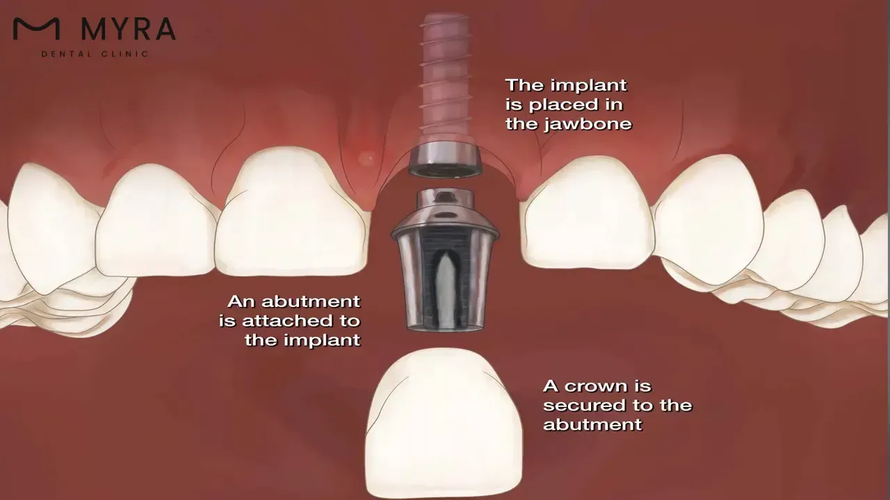 mini dental implant: definition, advantages, disadvantages, and average cost