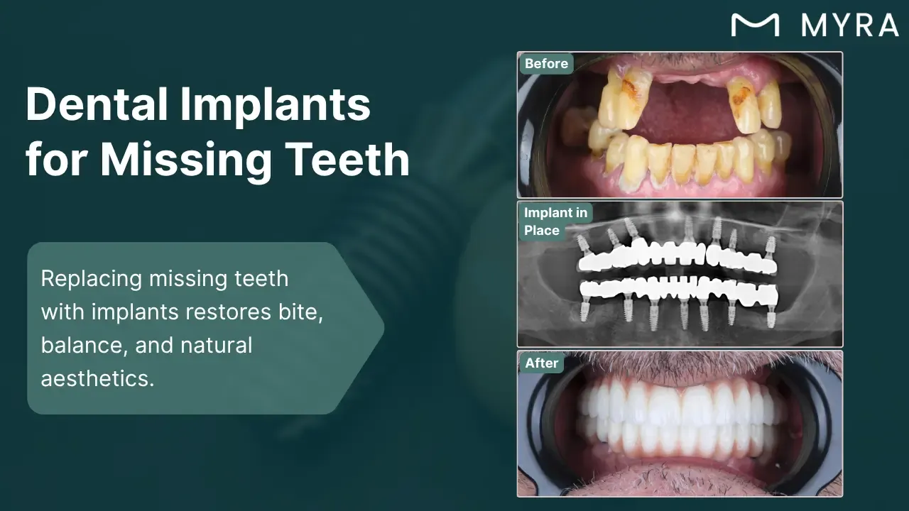 missing-teeth.webp