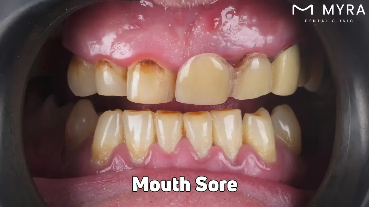 Mouth sore