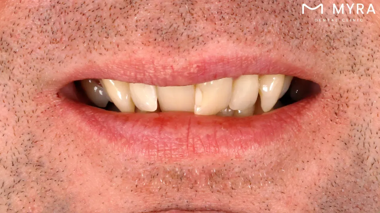 Narrow smile: Definition, causes, and how to fix it